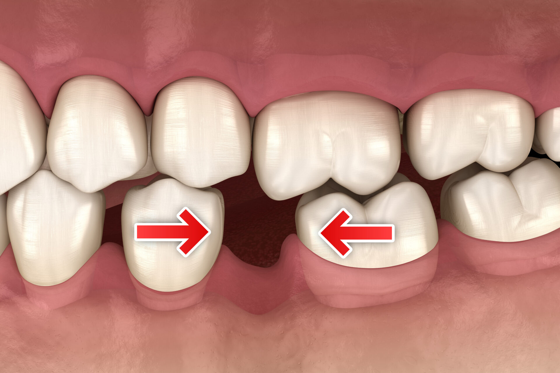 Implants Sant Dentaire St Eustache Dr Gabriel Leduc