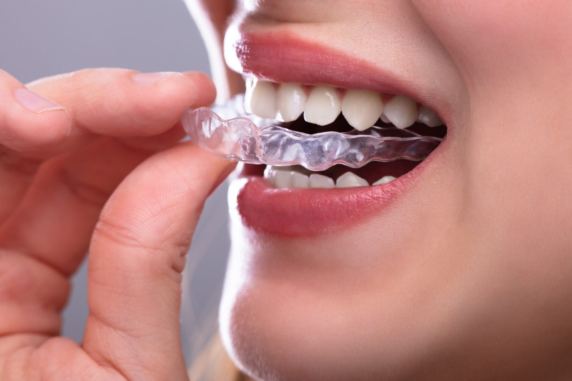 Plaque Oclusale pour protéger les dents