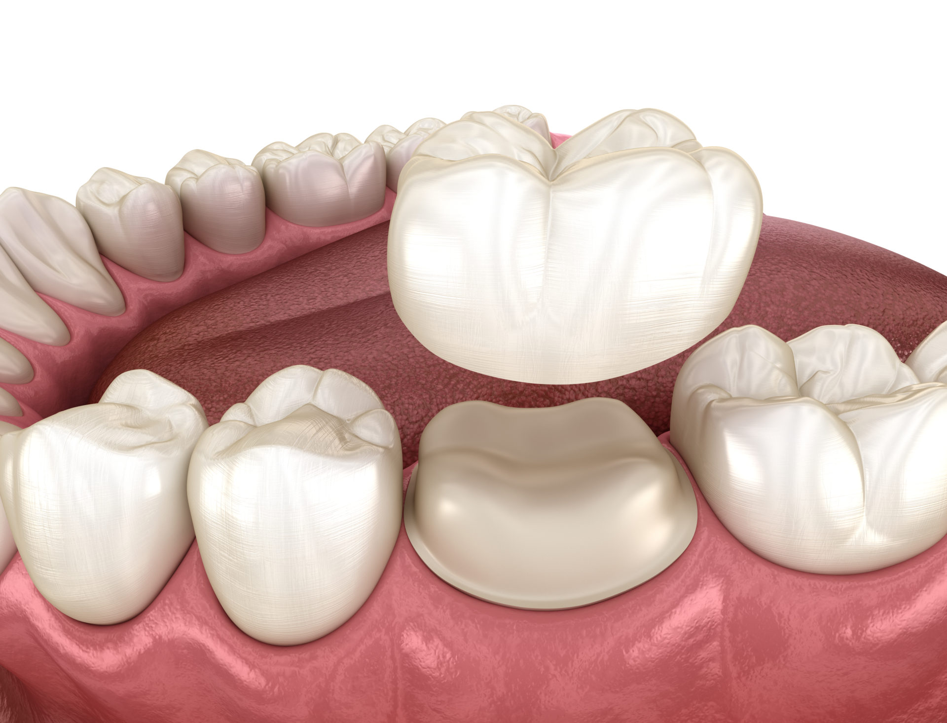 Couronnes dentaires: les explications simples des dentistes Vertuo