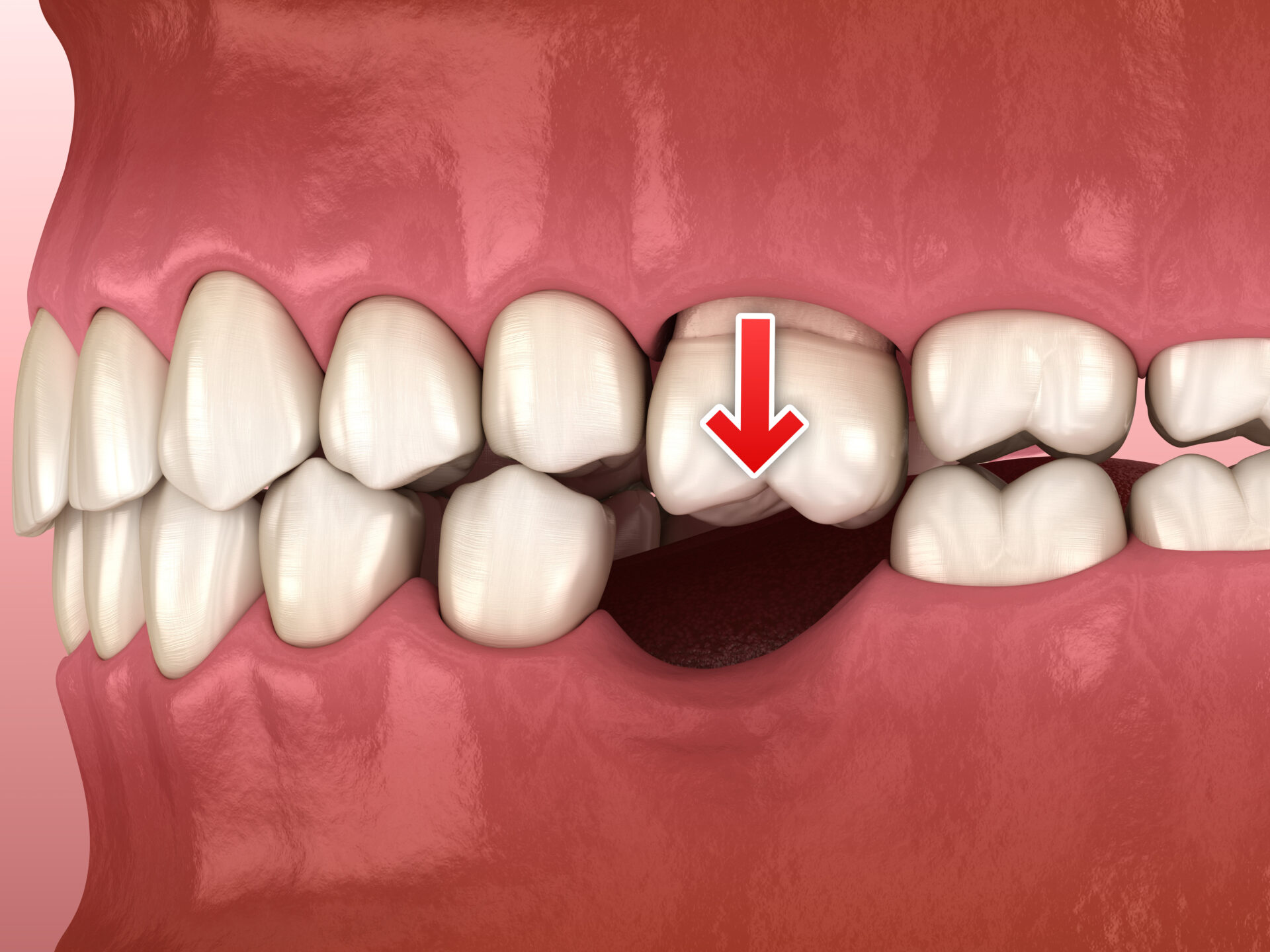 Implants - Clinique Dentaire Dr. Gabriel Leduc De Saint-Eustache